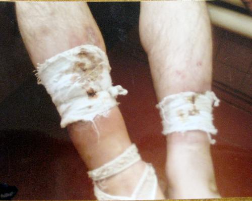 Следы пыток на ногах Зубайра Зубайраева. Лечебно-исправительное учреждение №15 (ЛИУ-15) Волгограда. Ноябрь 2008 г. Фото предоставлено адвокатом заключенного Мусой Хадисовым
