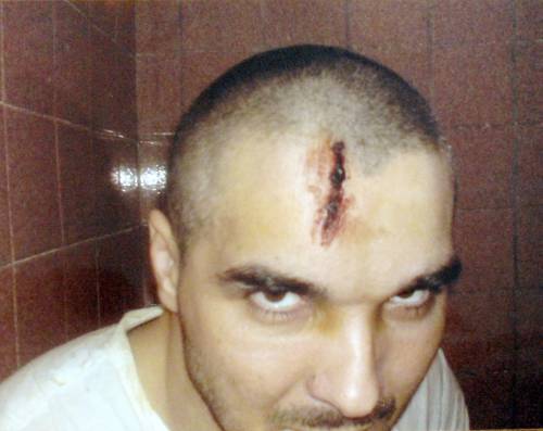 Рана на голове Зубайра Зубайраева. Лечебно-исправительное учреждение №15 (ЛИУ-15) Волгограда. Ноябрь 2008 г. Фото предоставлено адвокатом заключенного Мусой Хадисовым