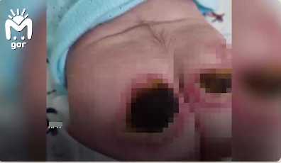 Скриншот из видео, где, как утверждает отец, запечатлены сильные ожоги на теле ребенка. Telegram-канал Mash Gor.